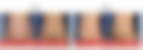 种植头发的危害是什么？感染、毛囊损伤、肿胀、瘢痕等问题逐一揭秘