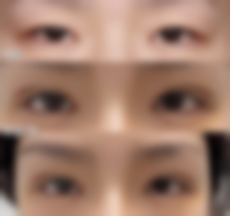 假体破裂造成的后果