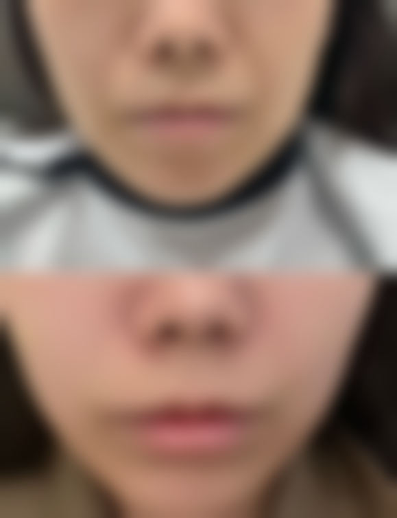 下颚骨手术有后遗症吗？有风险但多可恢复，做好这些能降低后遗症概率