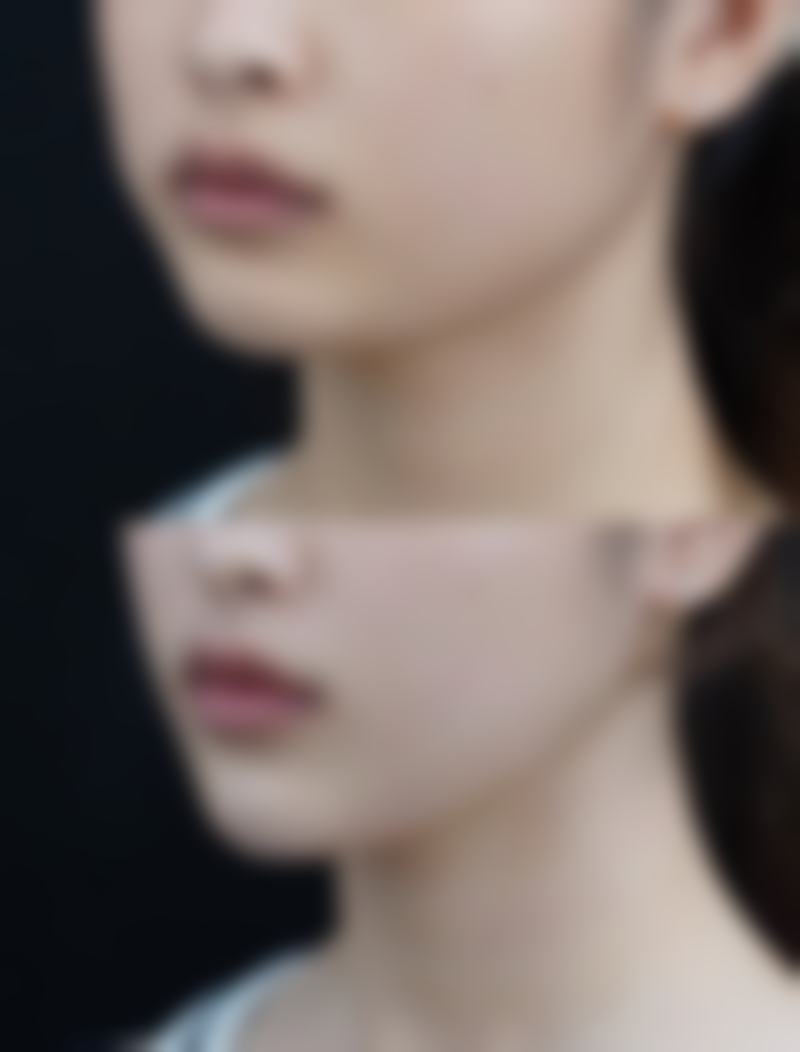 抽脂法眼袋术危险吗总结