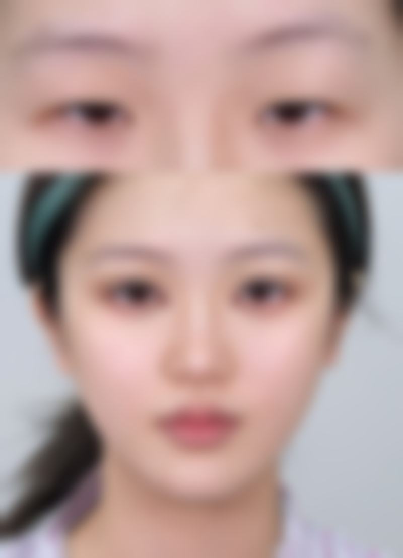 阴唇缩小手术的费用