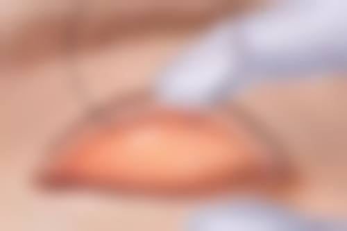 影响阴唇缩小手术修复时间的因素