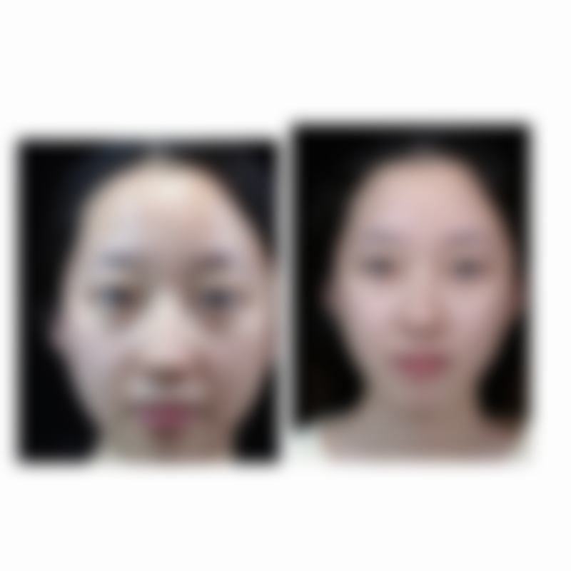 隆胸的其他潜在风险