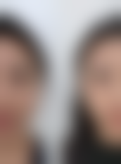 隆胸有替代方案吗