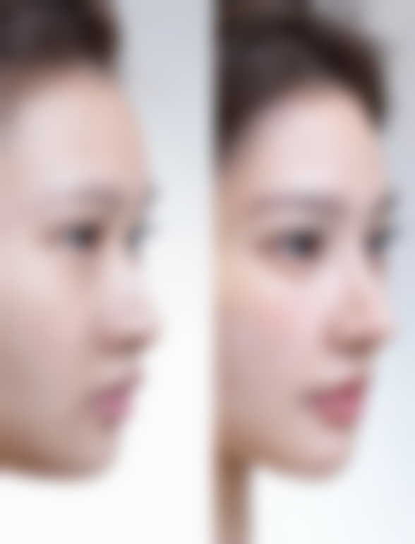 假体植入丰太阳穴有什么特点