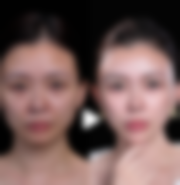 矫正前后的注意事项