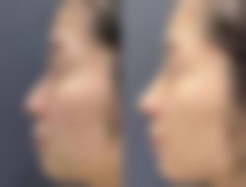 下巴吸脂手术危险吗：总结