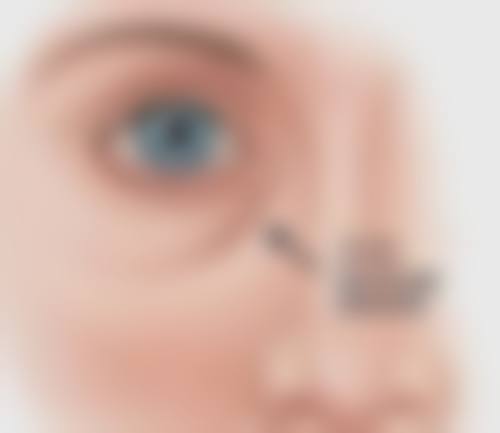 耳软骨隆鼻鼻头有点歪怎么办？不同阶段有啥处理招又咋避免和护理