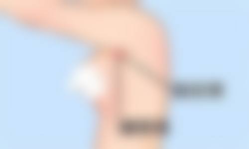 适合做bsk宫廷隆鼻的人群