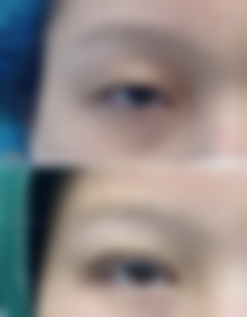 注射隆胸可以不取吗？材料、体质等多因素影响，需综合考量情况决定 