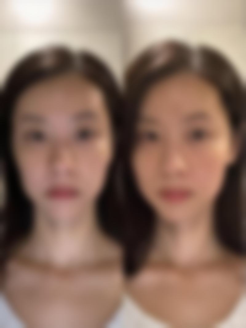 假体隆胸对身体危害大吗的总结