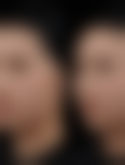 下巴吸脂手术危险吗？虽有风险但选对医院做好护理安全性可保障