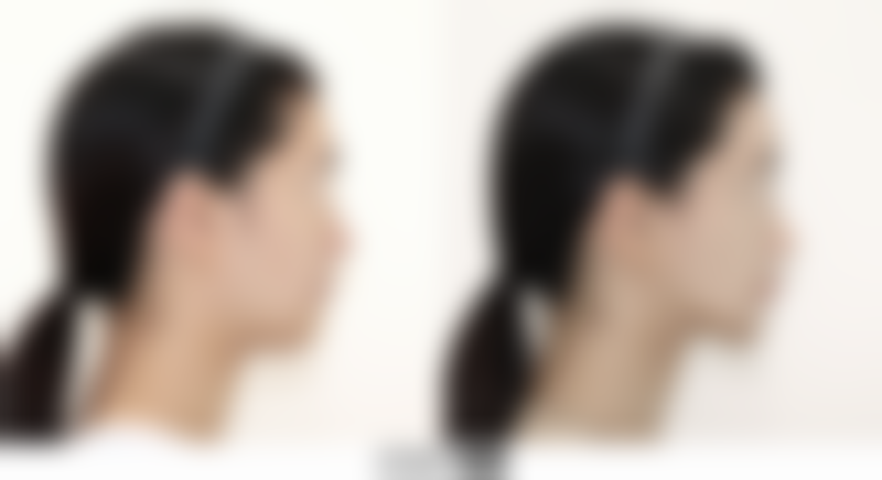 抽脂手术效果怎么样 能改善体型减轻体重但有风险该如何抉择