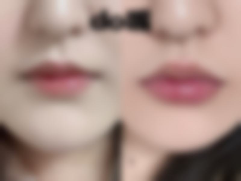 包茎环切手术环脱落的注意事项