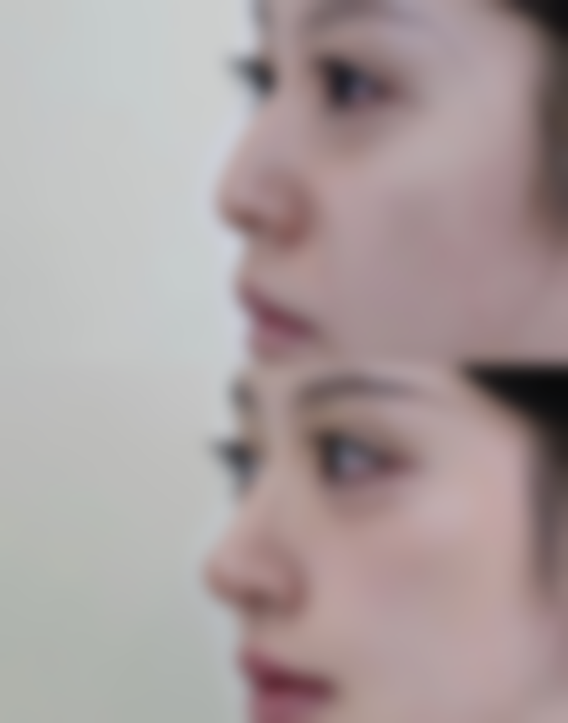 不同人群做肿眼泡抽脂手术的情况