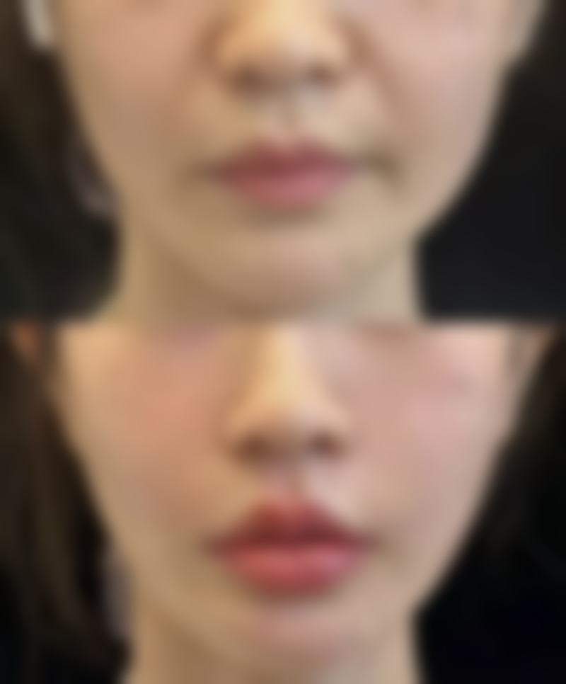 丰太阳穴可能存在的风险有哪些