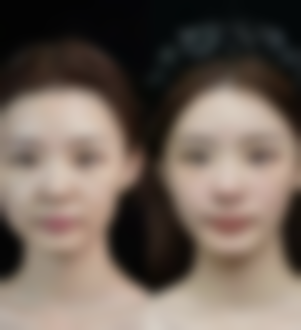 刚做完手术不久鼻头有点歪的处理方法