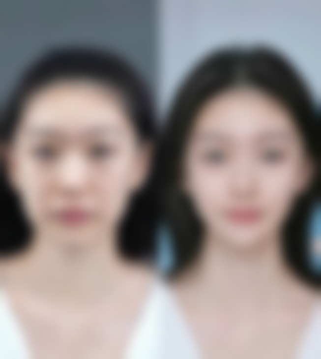 如何降低肿眼泡抽脂手术的副作用