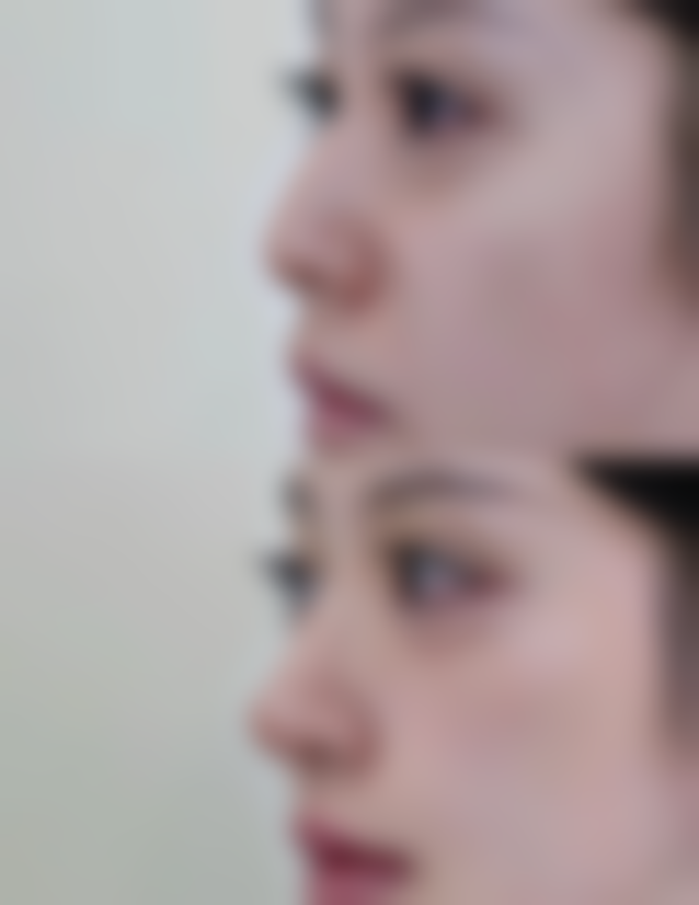 如何规避手臂吸脂手术的风险