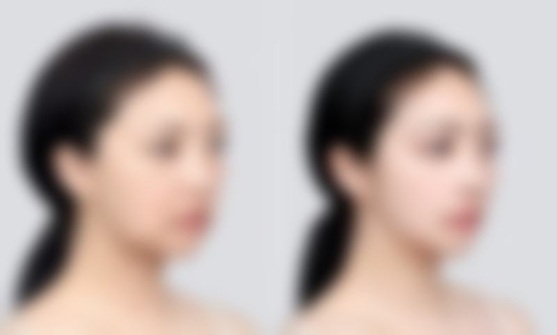 总结：14岁能做抽脂手术吗?