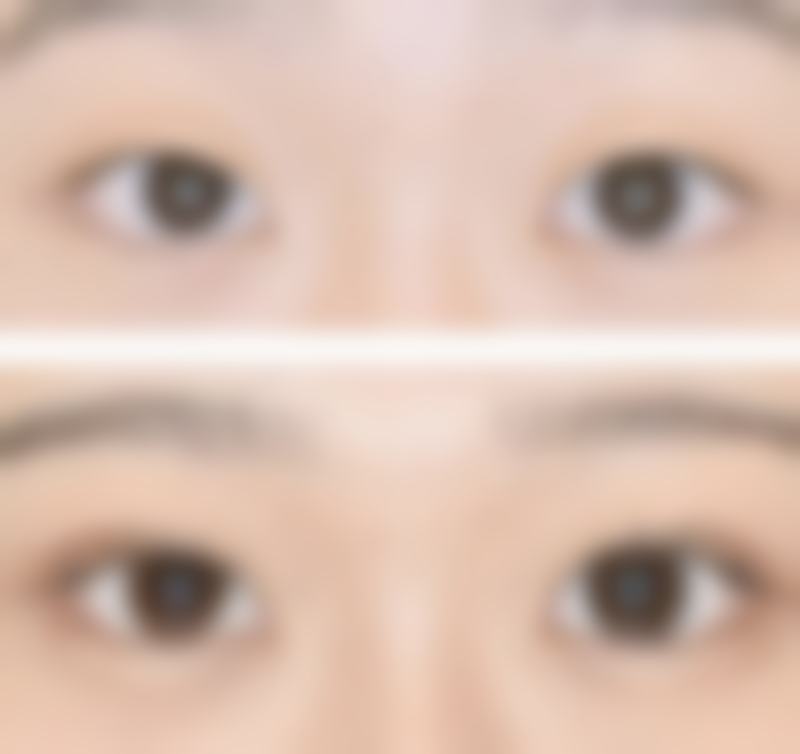 打瘦脸针过程中的注意事项