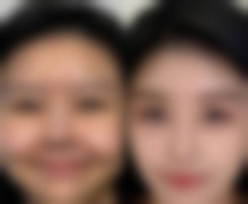 耳软骨隆鼻多久能侧睡？恢复时间因何而异又该注意啥