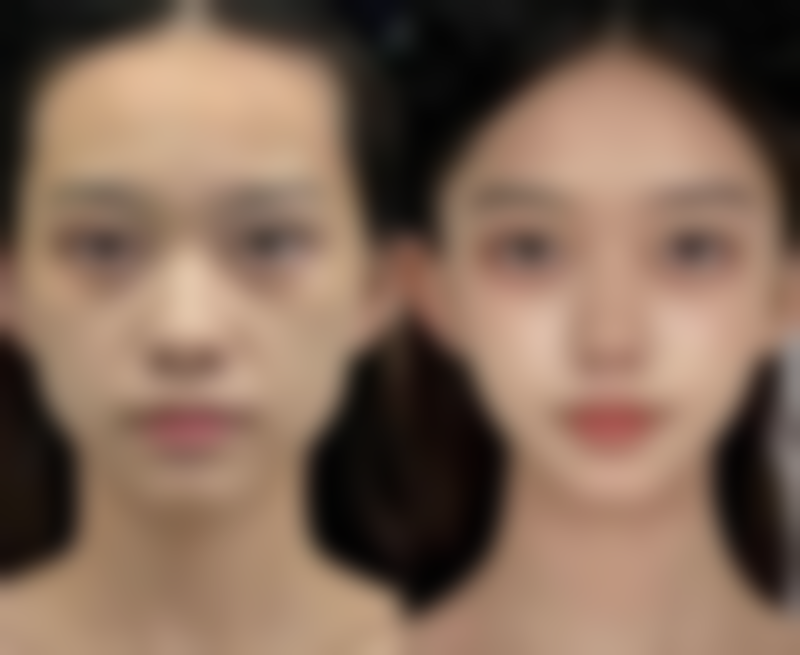 腿部吸脂手术有什么危害？皮肤凹凸、感染、栓塞等风险及后遗症了解一下