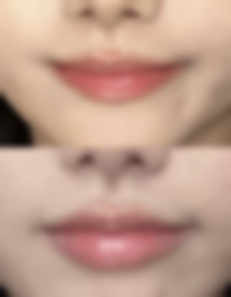 包膜挛缩的危害有哪些