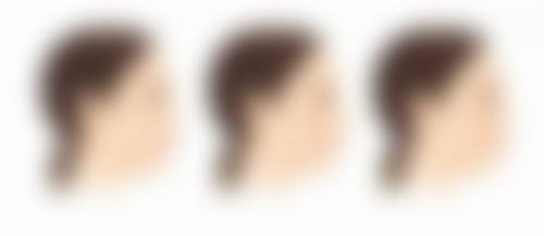 种植头发是自己的吗？一般用自身头发，毛囊不够咋办及咋选医院有答案