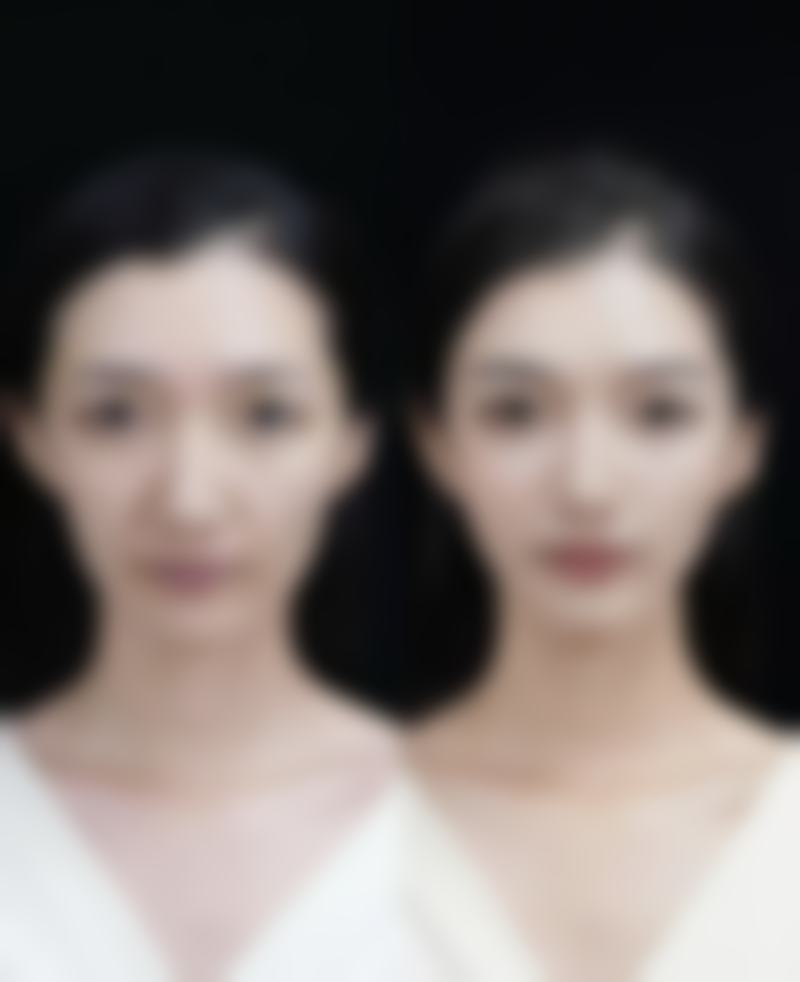 美白针里的氨甲环酸