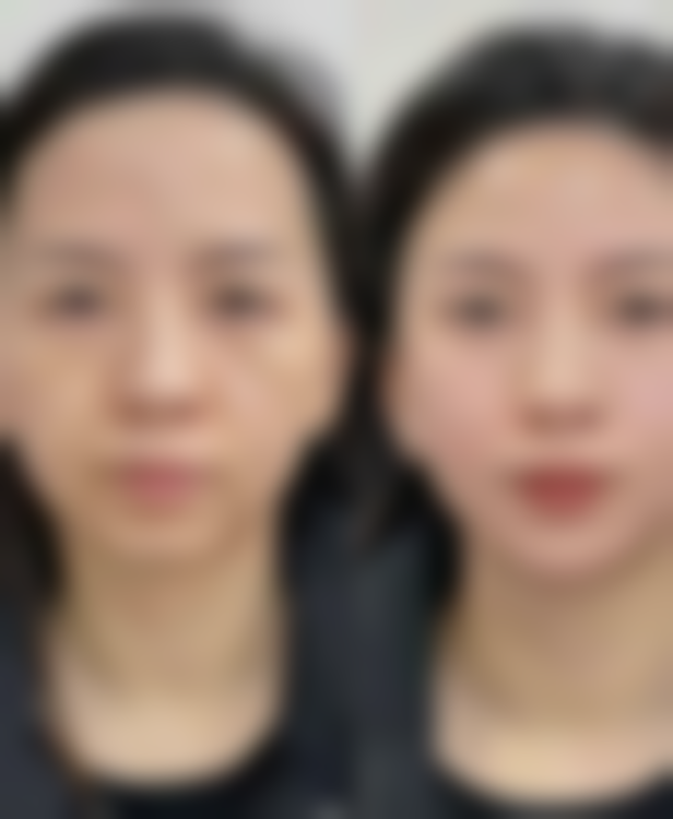 隆胸手术带来的生活不便