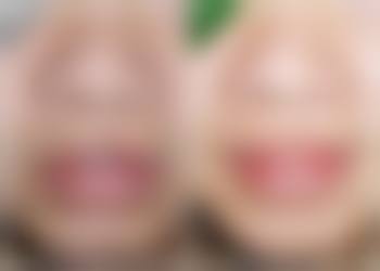 整容下颚骨引发的感染问题