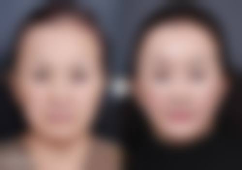 抽脂手术的修复问题