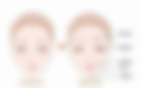 面部肌肉训练辅助矫正大人嘴凸