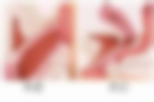 隆胸手术移位或变形的问题