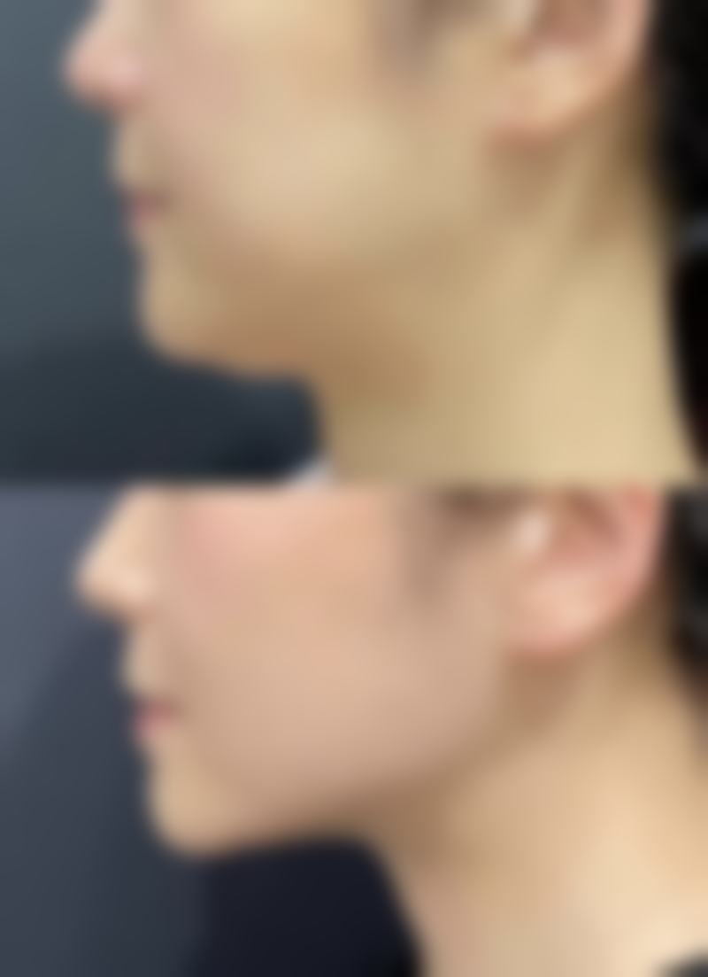 隆胸手术瘢痕增生的可能