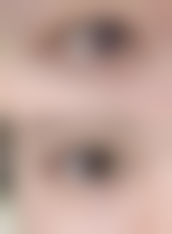 下嘴唇厚整形手术风险大吗