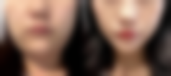 瘦脸针和美白针一起打有啥风险