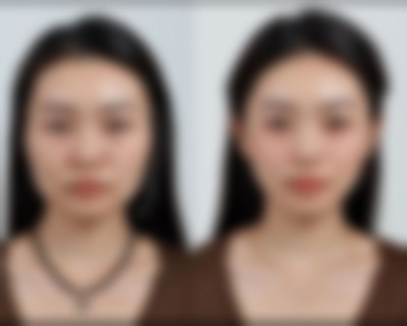 瘦脸针和美白针可以一起打吗？有风险，建议间隔打，术后护理和选医院也有讲究