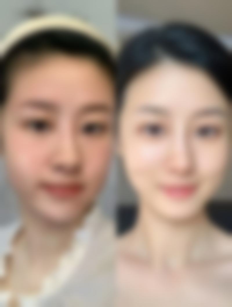 整容下颚骨带来的牙损伤问题