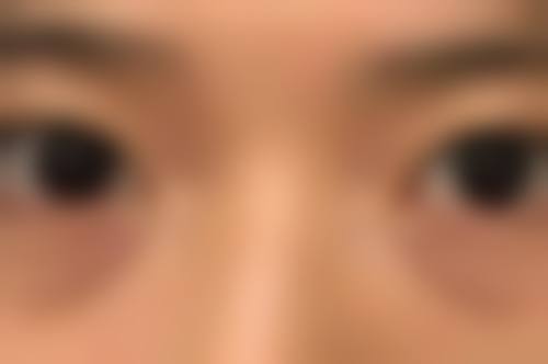 武汉斯启诺医美叶锋医生眼部整形口碑如何?