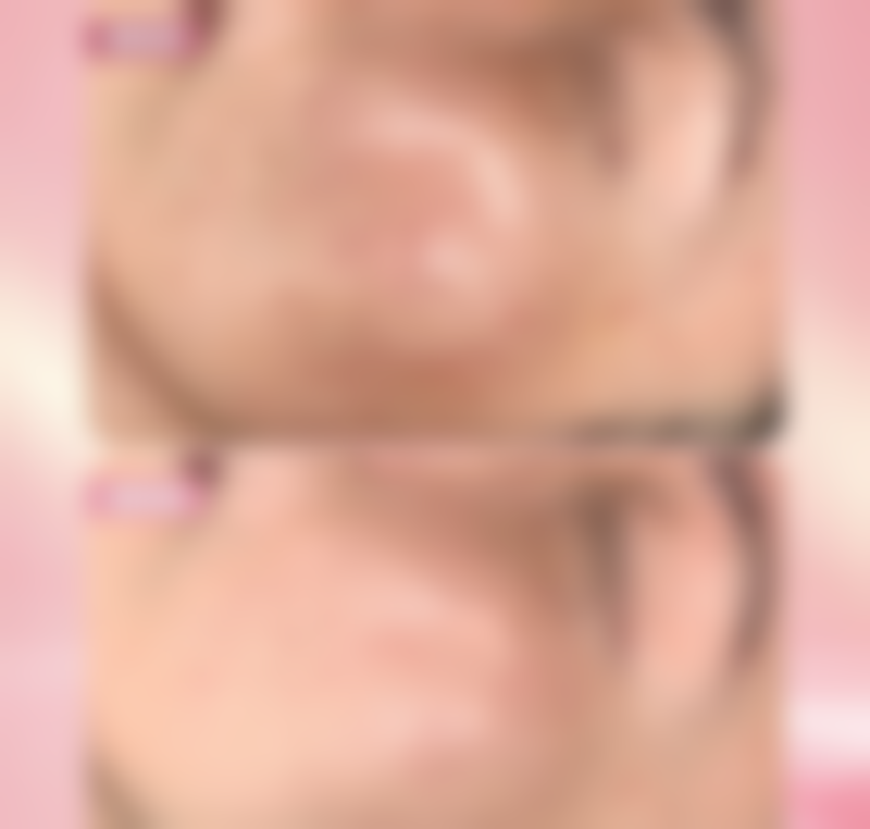 自体脂肪移植丰太阳穴