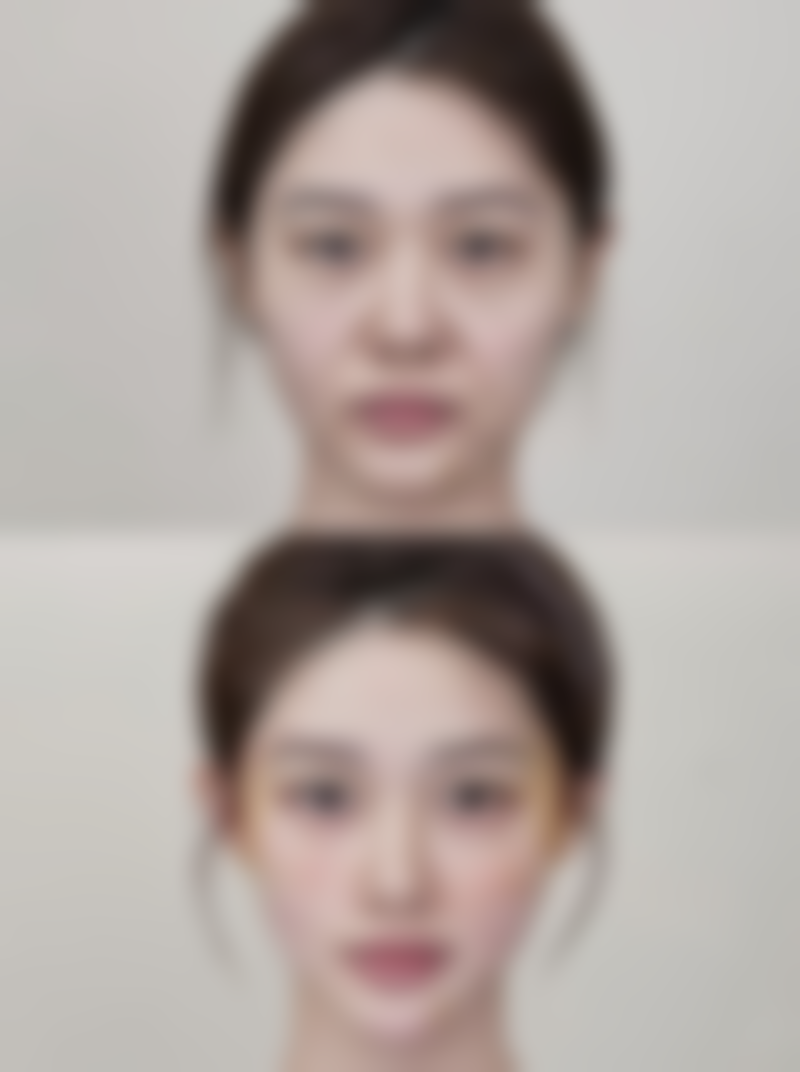 其他消除眼袋的方法