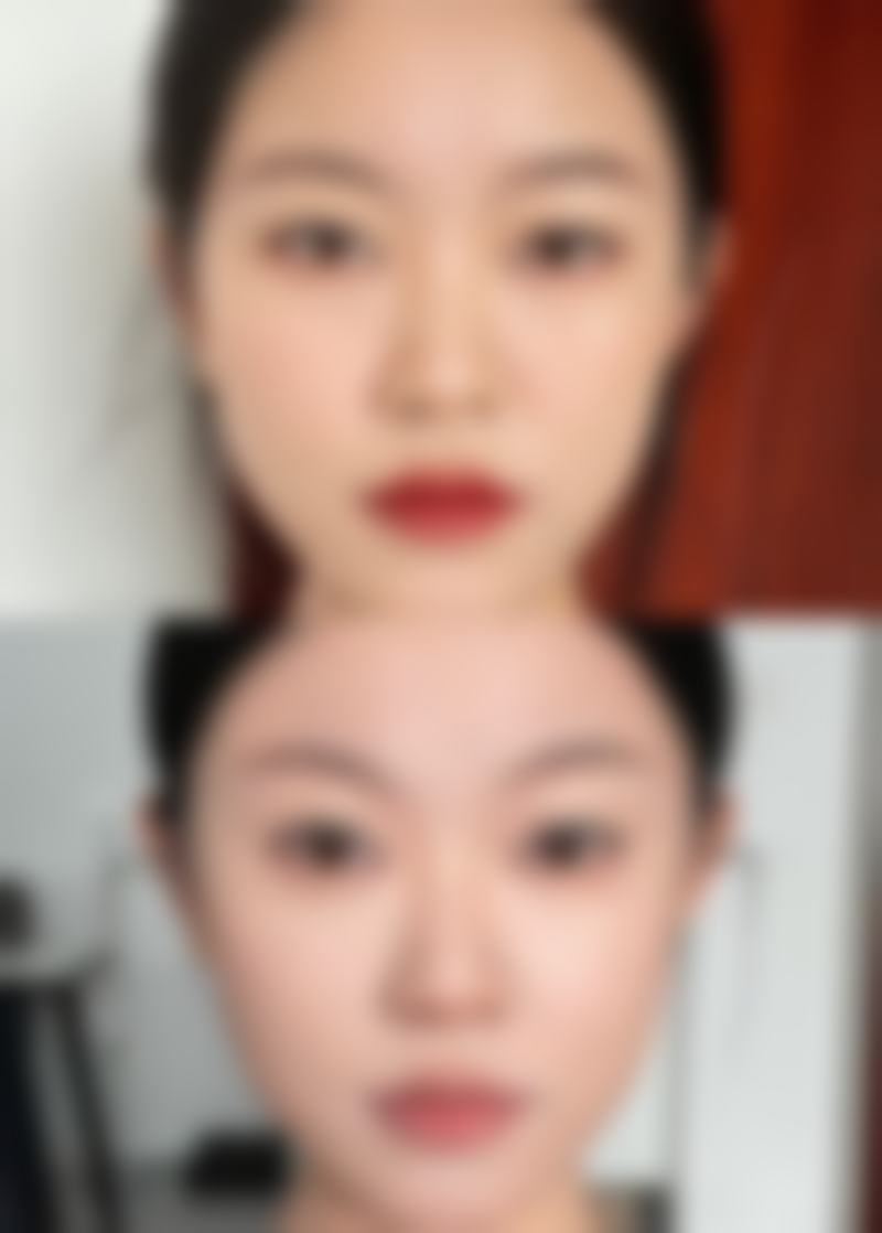 打隆鼻针可能出现的副作用