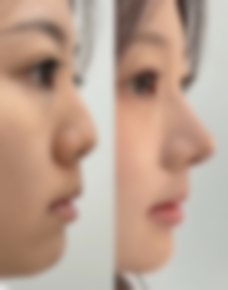 美白针和水光针的价格区别