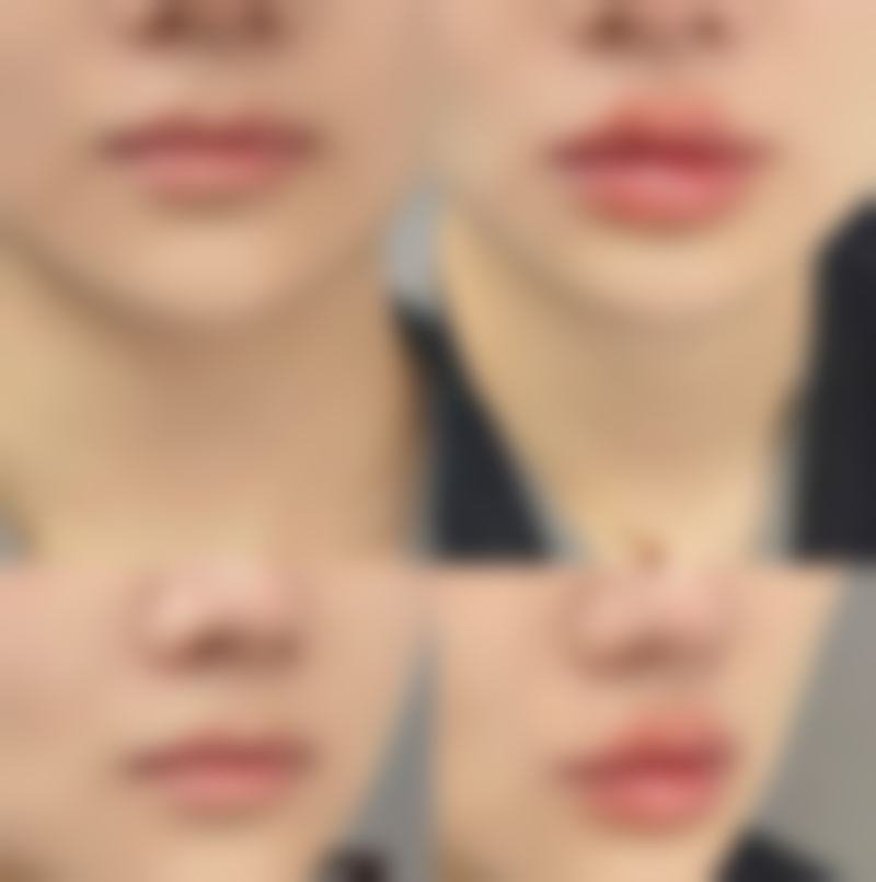 武汉斯启诺医美叶锋医生做眼袋整形技术怎么样?