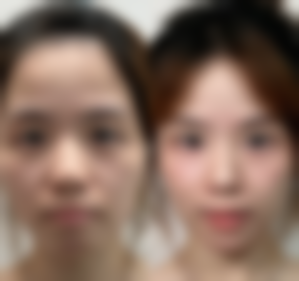 如何降低打隆鼻针的副作用