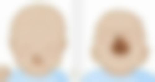 脂肪丰胸手术有危害吗