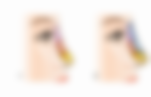 隆胸手术会带来哪些心理健康危害?