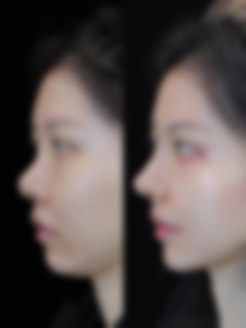 男性做抽脂手术的价格